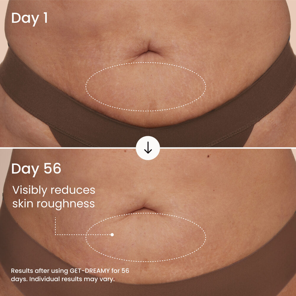 Before and after comparison of skin roughness reduction on a person's abdomen using GET DREAMY product.